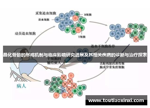 晶化骨髓的形成机制与临床影响研究进展及其相关疾病的诊断与治疗探索